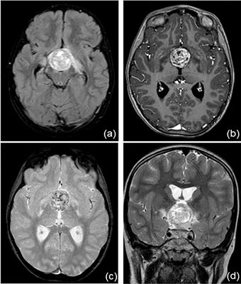 Case Report: SARS-CoV-2 Infection in a Child With Suprasellar Tumor and Hypothalamic-Pituitary Failure